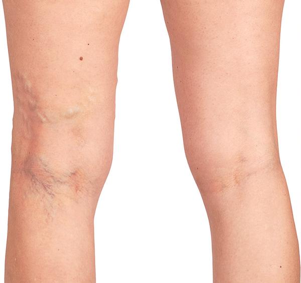Microsclerotherapy and lip fillers in Kent. Maidstone Aesthetics. Woman with spider veins on leg.